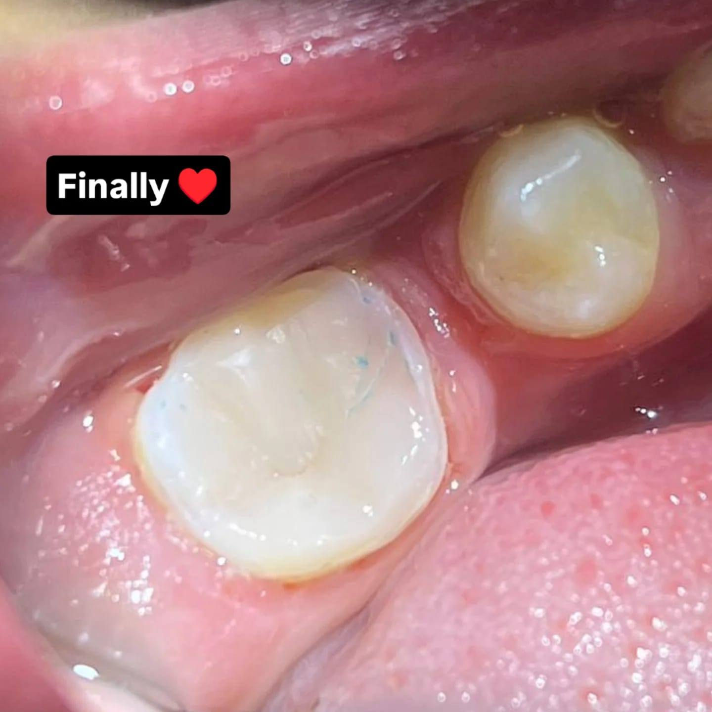 حشوة جذر واعادة ترميم شكل السن

المكان/ حي 17 الشارع العام لمكتبة المهندس مجاور لمدرسة المشاعل

للحجز والاستفسار/ ***********
