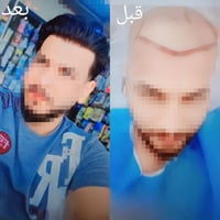 زراعة شعر • ٤ ميزو ٤ بلازما • مركز 123Hair