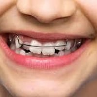 يوجد تقويم اسنان متحرك للاطفال #مجاني تحت 12 سنة  للاستفسار 0774994764...