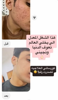 تركيبة • علاج الحبوب • آثار الحبوب