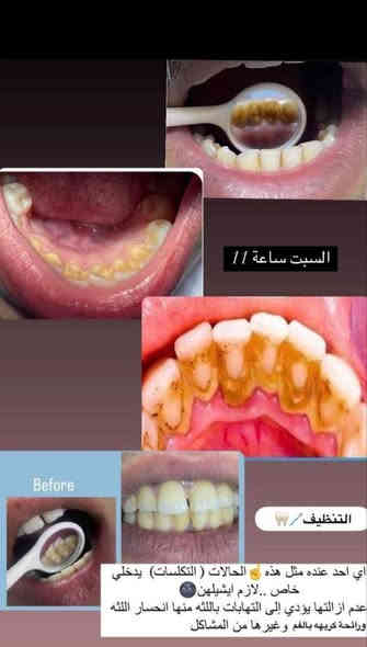 مجاناً ❗ 
- قلع الاسنان او الجذور المتبقيه 
- طقم اسنان ( تعويض الاسنان المفقوده) 
- حشوات ضوئية و معدنيه 
-تنظيف الاسنان و ازاله التكلسات 

علماً أن العلاج مجاني وتحت اشراف أطباء اختصاص
## يتوفر علاج أسنان الاطفال 

العنوان : بغداد- شارع مطار المثنى العسكري-  جامعة آشور- قرب العلاوي
@mohdt2 تلي گرام 
*********** واتساب

