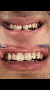 عيادة الماسة لطب الاسنان والتجميل 

العنوان 
الرمادي ـ جويبة ـ كيتار مول قرب جامع الرسالة 

للحجز والاستفسار 
***********

#عيادة #اسنان #جويبة #جويبه #الرمادي #عيادةـالماسة
#حشواتـتجميلية #سدـالفراغات بين الأسنان
