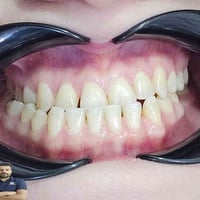 تقويم اسنان • تقدم الفك السفلي • المسيب شارع البلدية