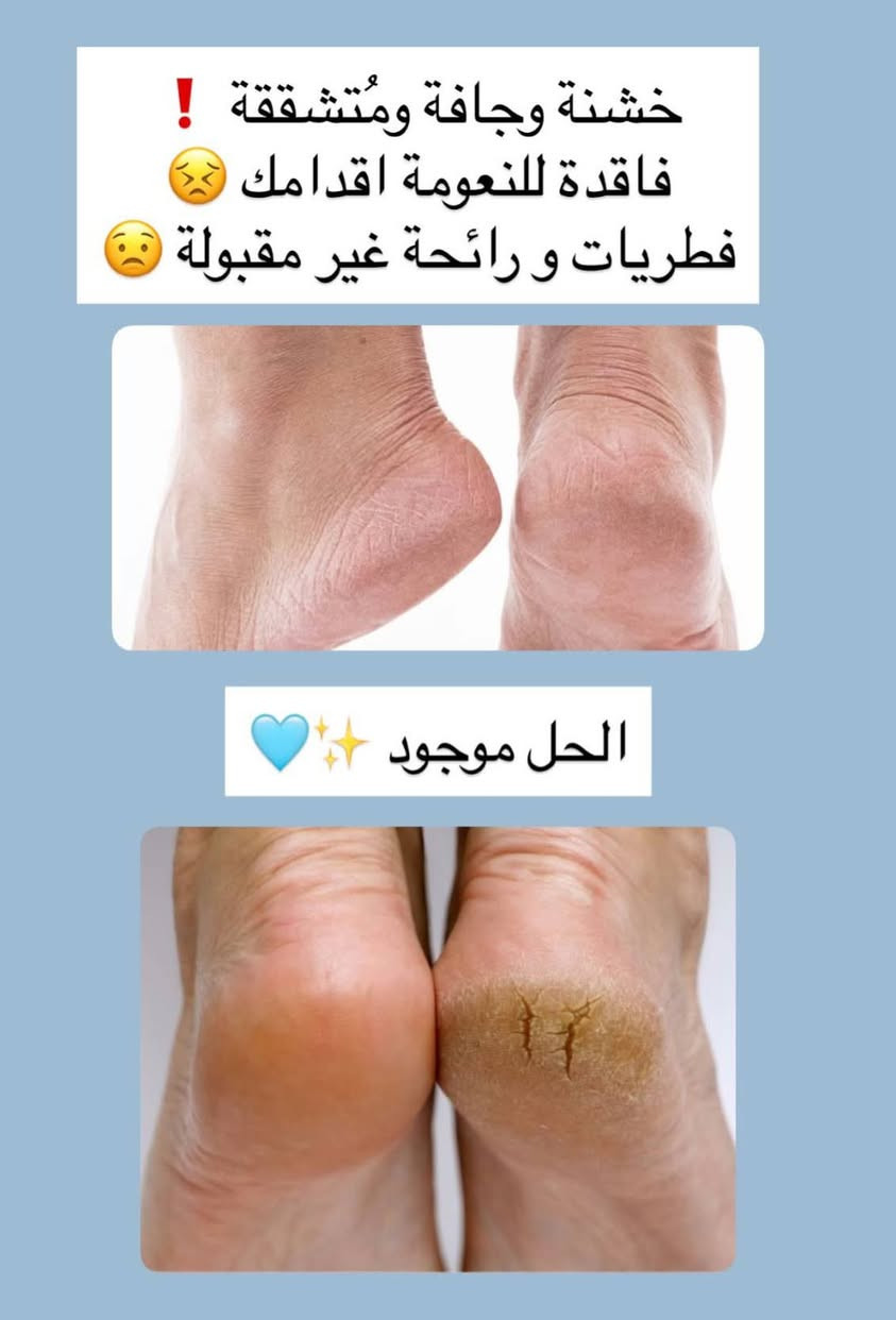 العناية بالقدم جزء مهم لصحة اقدامنا الي تحملنا طول اليوم 🩷 

لهل سبب ضروري يكون بروتينكم كريم يرطب ويرمم بشرة القدم ✨🎀
كعبك مالازم يبقى خشن ‼️
✨🩵

خيار مثالي ورائع للعناية بالقدم 🩷🎀
📌يحتوي على : 
📍10% يوريا (Urea): لترطيب وتنعيم الجلد
📍البروبيوتيك: لتعزيز الحاجز الواقي للبشرة
📍شمع العسل: لتغذية الجلد
📍مكونات مهدئة للبشرة الملتهبة أو الحساسة
قوام خفيف سريع الامتصاص ‼️✨

يعالج تشققات الكعبين العميقة✅
يساعد على تجديد البشرة المتضررة والخشنة✅
.
. العنوان ذي قار الشطره شارع الكص فرع جامع الرسول وقرب مجمع نازك 
تتوفر خدمه توصيل لجميع محافظات العراق 
.


**إذا كنت صاحب هذا الإعلان وتريد حذفه لأي سبب، رجاءا أرسل رسالة إلى الدعم الفني**