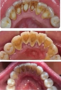 متوفر علاج مجاني لهيج حالات 07782310901 موقع كرادة شارع ٥٢