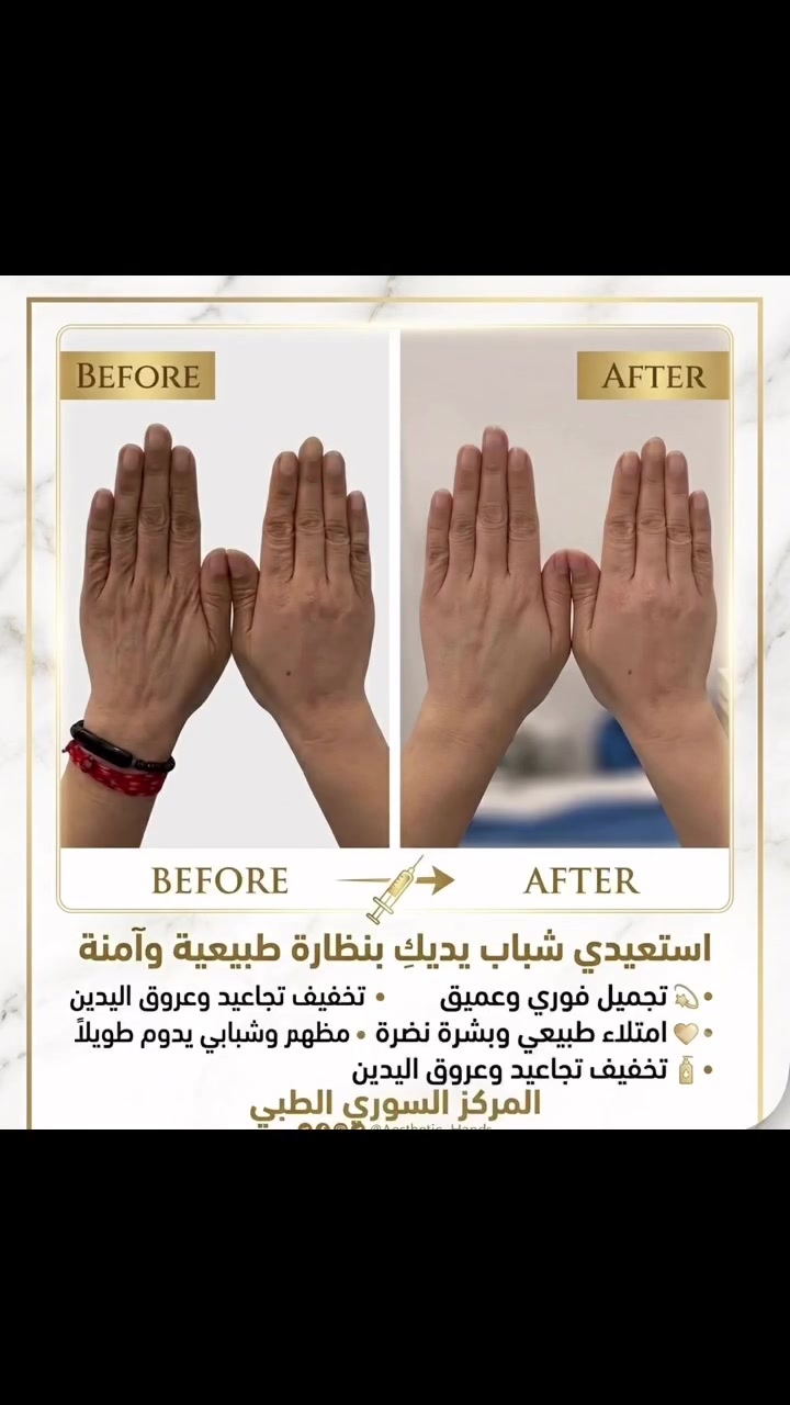 المركز السوري الطبي
😍😍😍 😍💉🥼🩵
كافة خدمات التجميل متوفرة بمركزنا ( للنساء والرجال )
وتحت أيادي أطباء اختصاص
متواجدين كل أيام الأسبوع
المعاينة مجاناً
جلسات تجميل وعلاج اليدين ✨🖐️
 تخفيف فوري للتجاعيد وعروق اليدين البارزة.
 امتلاء طبيعي وبشرة نضرة ومشدودة.
 استعادة شباب وحيوية اليدين بمظهر صحي.
الاستمرارية على الجلسات ونوع العلاج (فيلر أو بلازما أو بروفايلو) تُحدد من قبل الطبيبة وحسب الحالة، والمتابعة العلاجية مع الطبيبة تضمن لج نتائج علاجية مبهرة ومظهر يدوم طويلاً.
❤️❤️
#فلر_يدين #تجميل_اليدين #مدينة_الصدر #المحمودية
#المركز_العلاجي #المركز_السوري_الطبى
العنوان: المحمودية - تقاطع العزاب (المجمع) - قرب مقر الفوج الثاني سابقاً.
للحجز والاستفسار: مراسلة الصفحة أو الاتصال على الأرقام التالية:
📱 ***********
📱 ***********

