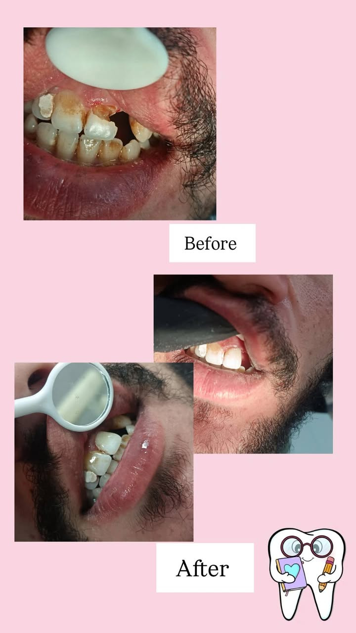 📢 إعلان لمرضى الأسنان 🦷✨
أنا طالبة طب أسنان - المرحلة الخامسة في جامعة دجلة. 
أعمل حاليًا على استقبال حالات علاجية داخل الكلية وتحت إشراف مباشر من أساتذة وأطباء متخصصين لضمان أفضل رعاية ممكنة.

🔹 تتوفر العلاجات التالية مجانًا/بأسعار رمزية (حسب نظام الكلية):

الحشوات التجميلية والعلاجية.

تنظيف الأسنان وإزالة الترسبات الجيرية.

علاج الجذور (حشوة العصب).

معالجة اللثة البسيطة.

أطقم الأسنان الجزئية والكاملة

علاج اسنان الاطفال 

✅ العلاج يتم بجودة عالية وتحت متابعة مشددة من الكادر الطبي.
✅ فرصة للاستفادة من خدمات أسنان آمنة واحترافية.

📍 المكان: الدورة - شارع المصافي / كلية دجلة الجامعة 
📞 للتواصل وحجز الحالة: ماسنجر /او عبر الرقم في الكارت


**إذا كنت صاحب هذا الإعلان وتريد حذفه لأي سبب، رجاءا أرسل رسالة إلى الدعم الفني**