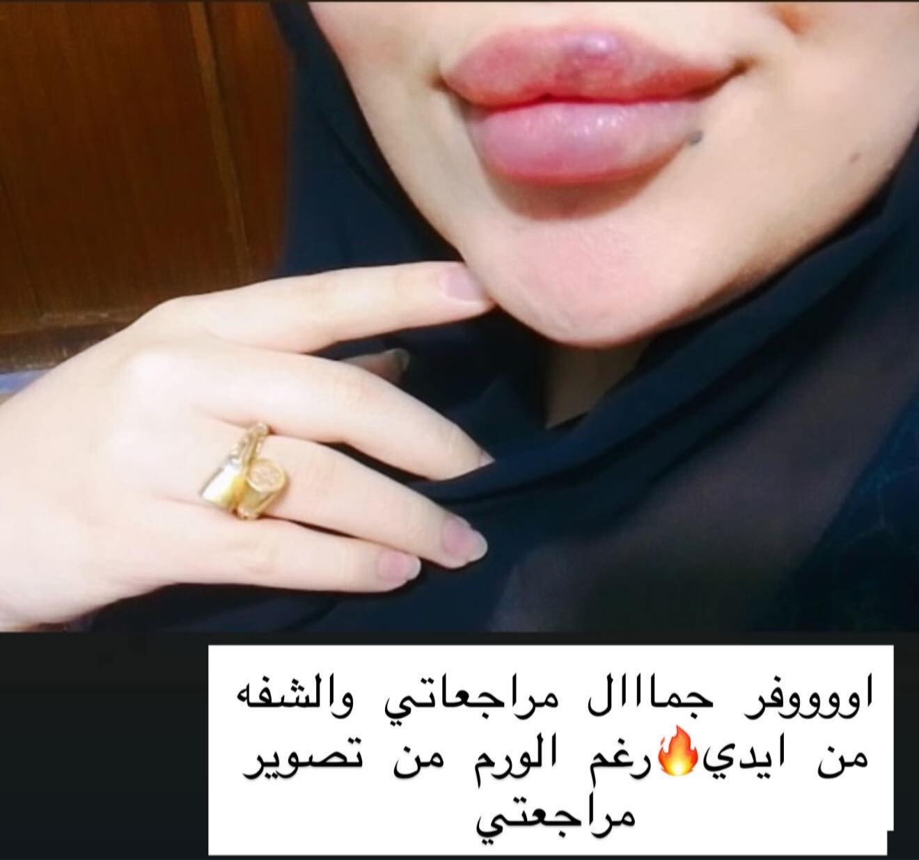 فلر شفة تعديل ع حقن سابق 🔥
من تصوير مراجعتي ✨
عرووووض شهر رمضان ثبتتهه الكم بالهايلايت بالستوري وببوست اعلى الصفحة ✨
د.ايثار سامي عبد الامير 
الكوت_الهورة_مجمع القبطان_طابق اول
الحجز***********
