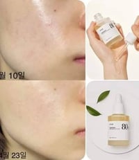 أنوا هارتليف • ٨٠٪ ترطيب • مهدئ حب الشباب