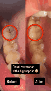 ✨ علاج أسنان مجانًا وبإشراف أطباء اختصاص ✨
السلام عليكم 
• حشوات ضوئية للأسنان الأمامية والخلفية
 • قلع الأسنان المتحركة والتالفة
 • تنظيف وتلميع الأسنان
 • تعويضات جزئية متحركة
 • كل الشغل يتم بإشراف دكاترة اختصاص من الجامعة لضمان أفضل نتيجة

📍 الموقع: جامعة أوروك – كلية طب الأسنان – شارع 52 / الكرادة
📅 المواعيد: يوم الأحد والاثنين
😊 خلي ابتسامتك ترجع بثقة

📞 للتواصل: ***********
