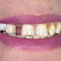 تركيبات زيركون • عيادة البتول • ميسان الماجدية