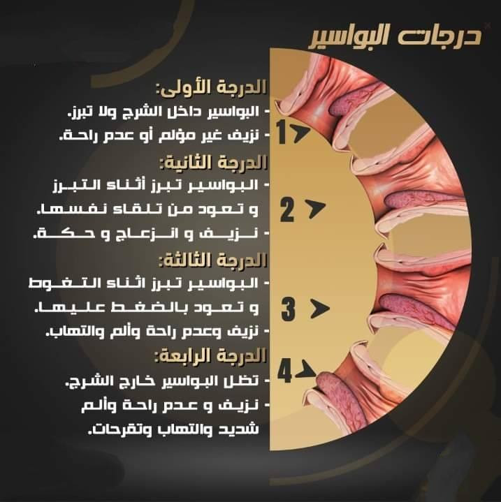 من الامراض الشائعة جدا في مجتمعنا هي تضخم البواسير الشرجية. 
المضاعفات التي قد تنشأ نتيجة لعدم علاج البواسير هي... 
النزيف
 الحكة وعدم الراحة
تكون تجلط دم في الباسور مما يسبب الألم. 
العلاج الامثل هو الاستئصال الجراحي. 

للاستفسار يمكنكم التواصل على الرقم
***********
***********
ابو غريب / النصر و السلام / شارع ٣٠ / شارع ملوكة نهاية خط الكيات مقابل مطعم زرزور مجاور صيدلية غفران سامي مجمع الرازي الطبي  

#ابوغريب
#النصروالسلام
#مجمعات
#مجمعات_طبية 
#اكسبلور_فولو
#اكسبلور
