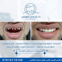 ابتسامة زركون • فك علوي • قضاء النصر