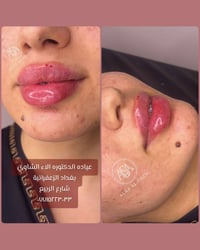 الشفه الكرزية 🔥 وبدون اي فلتر او كلوس  حقن تراكمي وصلنا لهل النتيجه ال...