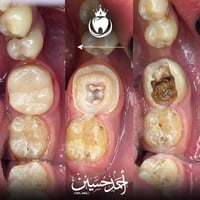 ترميم ضرس • حفظ السن • د. احمد الطعماوي