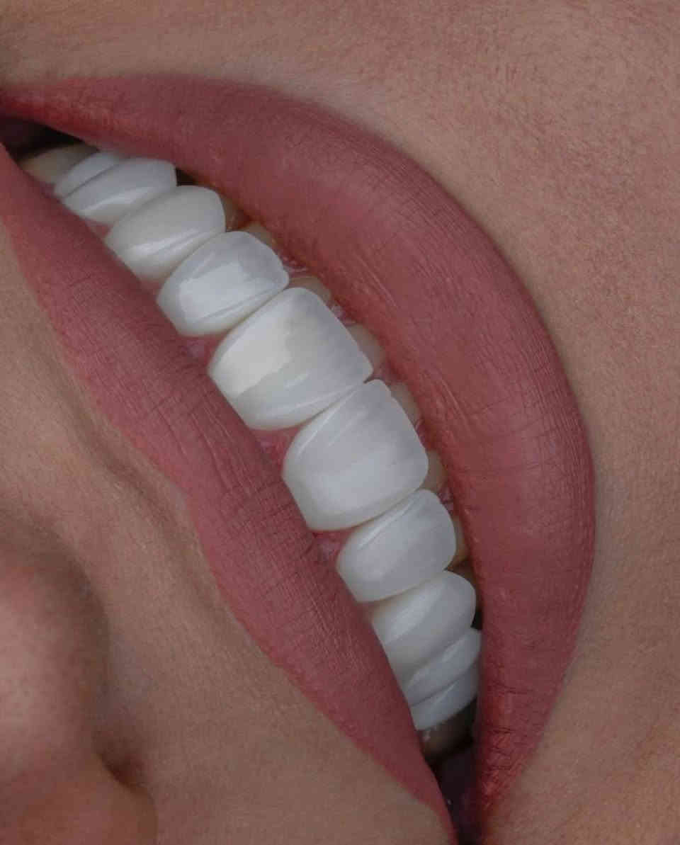 قبل وبعد… فرق واضح 😍
جودة عالية ✅
طبيعي 100% ✅
ابتسامة تدوم ✅

عيادة سومر خيارك الافضل ✨ 
الدكتور موسى محمود الكعبي / مجمع سومر الطابق الثاني 
📞 ***********
