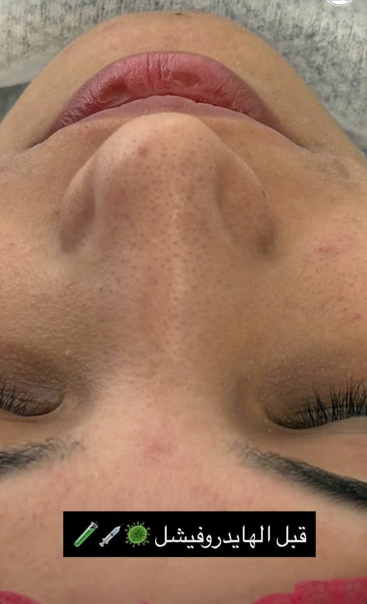 عروض البشره مستمره مع صالون واو بيوتي 

تنظيف بشره بجهاز الهايدروبيوتي بسعر ١٥ الف فقط 

تنظيف بشره عميق مع ابره نظاره بسعر ٢٥ الف فقط 

العنوان الحريه تقاطع مصور عيسى مجاور مجمع اطلس


**إذا كنت صاحب هذا الإعلان وتريد حذفه لأي سبب، رجاءا أرسل رسالة إلى الدعم الفني**