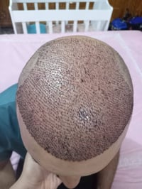 عيادة استيرا • زراعة شعر • رمادي