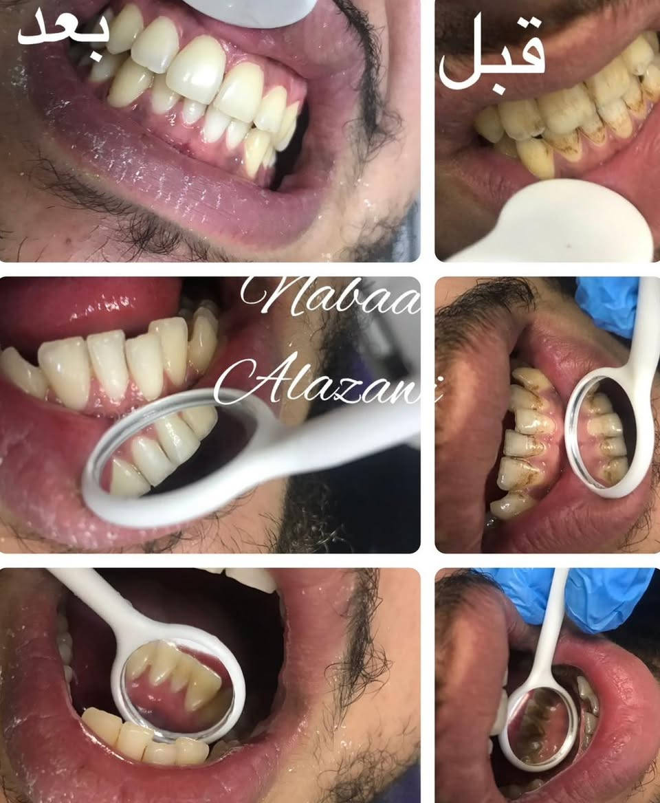 الى/ اهالينا في المجمع السكني النفطي والمناطق المجاورة

إعلان افتتاح عيادة أسنان 🦷

تعلن عيادة : (جوري) لطب الاسنان والتجميل
عن افتتاحها رسميًا وتقديم أفضل الخدمات العلاجية والتجميلية بأحدث الأجهزة والتقنيات الحديثة.

🔹 فحص وتشخيص دقيق
🔹 حشوات وتجميل الأسنان
🔹 تنظيف وتبييض
🔹 خلع وعلاج جذور
🔹 ابتسامة صحية باشراف طبي  متخصص
🔹تقويم الاسنان و بنظام الاقساط
اضافة الى عروض قسم التجميل والبوتوكس 
📍 العنوان: عمارة الكناني
📞 للحجز والاستفسار:***********
