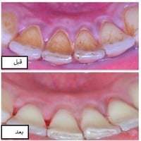 تنظيف مجاني • حشوات تجميلية • قلع أسنان