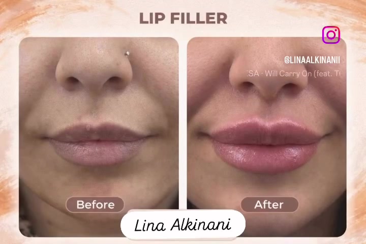 😍عرووووووض العيد 😍
😍 ✨ عيادة النبضة التجميلية ✨😍
لأن جمالج يستحق عناية بأدق التفاصيل 💉🤍

نوفر أحدث تقنيات التجميل اللاجراحي بأيدي خبيرة ونتائج طبيعية راقية ✨
🔹 حقن الفيلر
🔹 البوتكس
🔹 الميزوثيرابي
🔹 البلازما PRP
🔹 تفتيح ونضارة البشرة
🔹 جلسات الهيدرافيشل والعناية الملكية
🔹 علاج التصبغات والهالات
🔹 تحديد وكونتور للوجه والشفايف

نهتم براحتج، تعقيم عالي، وشغل ناعم يبرز جمالج بثقة وأناقة 💎

📍الموقع: بغداد – حي العامل-الجنابات -قرب روضة النسرين
🏥 عيادة النبضة التجميلية
***********

احجزي موعدج وخلي جمالج ينبض ثقة
