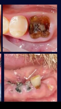 خلع جذور • طقم اسنان • جامعة اهل البيت