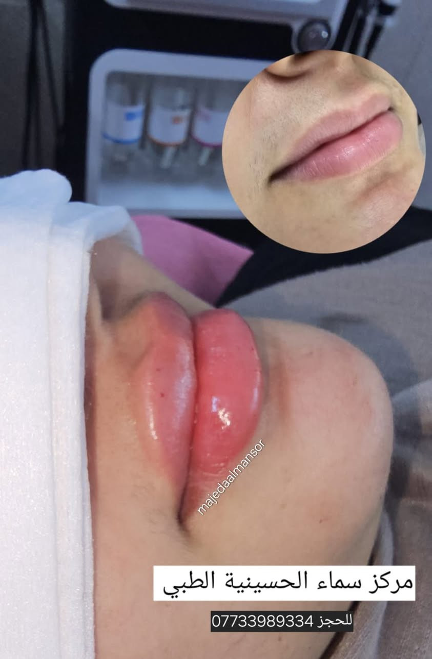 بمواد أمنه وأصلية 
 الحقن ورسم الشفاه حسب اختياركم 
ع يد خبيرة التجميل والمدربة الدولية
 الدكتورة ماجدة المنصور Jojo Alnabeel 
العنوان بغداد الحسينية مقابل السوق الكبير مجاور مرطبات العذراء
مجمع سما الحسينيه للطابق الثاني قسم التجميل والصالون ***********
