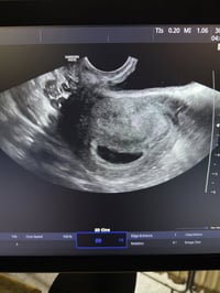 عقم أولي ٣ سنوات • حمل ٥ أسابيع • كركوك حي الحجاج