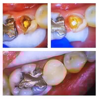 ترميم سن • زركون ياباني • بغداد الشعب