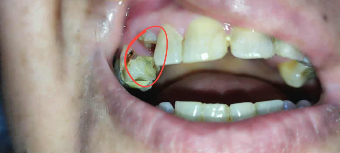 قلع الأسنان -مجاناً
ان شاء الله متواجدين  الان على هذ الرقم بالواتساب للحجز.
***********
