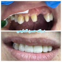 تركيبات أسنان • د.رائد الدليمي • جبلة حي العسكري