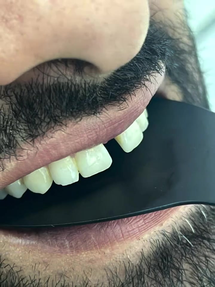 ليش تنتظر شهور إذا الحل موجود اليوم؟ 🚨🦷
غلق الفراغات خلال جلسة وحدة بس 🔥
راحة + نتيجة فورية = ابتسامة واثقة 💎
تابع للنهاية وشوف الفرق الحقيقي 👇

ومثل ما معوديكم السعر جدا مناسب 
راسلونا ع الخاص  للحجز والاستفسار 
او على الرقم ***********
بغداد الحسينية مدخل التكاسي مقابل صيدلية الطاقة الدوائية 

العيادة الاولى لطب الأسنان …غايتنا هي رضاكم وخدمتكم Sama
