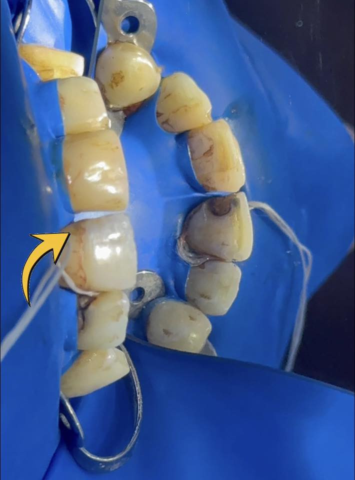 ⁨ معالجة التسوسات بحشوة ضوئيه بجلسة واحده 👀. 
👨🏻‍⚕️الدكتور علي حسين داود 

📍عيادة الغدير لطب وتجميل الأسنان 
قرب فلكة الصدرين مجاور صيدلية علي هاشم الموسوي 
📞***********

