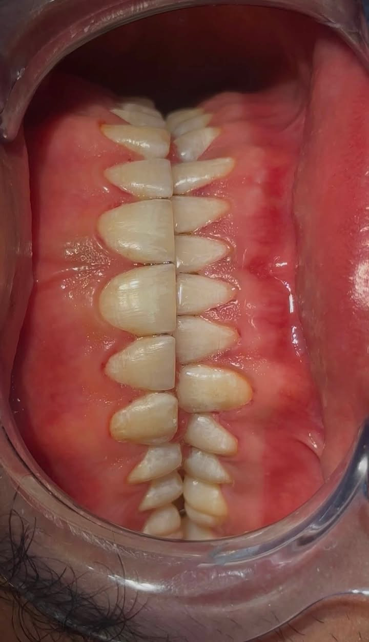 تنظيف الأسنان وازالة التكلسات والتصبغات بجلسة واحدة فقط 
عيادة الغدير لطب وتجميل الأسنان
📍قرب فلكة الصدرين/ بناية الدكتور الصيدلاني علي هاشم الموسوي 
الدكتور علي حسين داود


**إذا كنت صاحب هذا الإعلان وتريد حذفه لأي سبب، رجاءا أرسل رسالة إلى الدعم الفني**