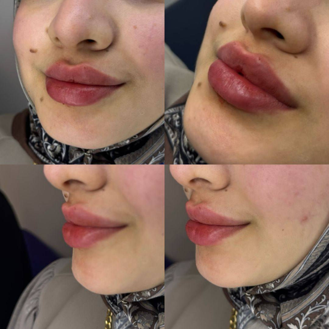 عروض عيد الحب 🫀❤️
حنين العزاوي – Haneen Alazzawy ✨
دقة، ذوق، ونتيجة تفتح النفس ❤️
📍 المكان: بغداد – الحسينية❤️
مقابل كراج الأسدي❤️
عيادة خبراء الطب التخصصي❤️
📞 رقم الهاتف: ***********
