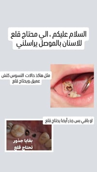 قلع اسنان • مجاني • جماعة النور