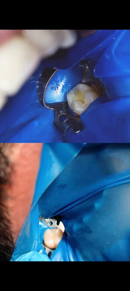 📢 إعلان لمرضى الأسنان 🦷✨
أنا طالبة طب أسنان - المرحلة الخامسة في جامعة دجلة. 
أعمل حاليًا على استقبال حالات علاجية داخل الكلية وتحت إشراف مباشر من أساتذة وأطباء متخصصين لضمان أفضل رعاية ممكنة.

🔹 تتوفر العلاجات التالية مجانًا/بأسعار رمزية (حسب نظام الكلية):

الحشوات التجميلية والعلاجية.

تنظيف الأسنان وإزالة الترسبات الجيرية.

علاج الجذور (حشوة العصب).

معالجة اللثة البسيطة.

أطقم الأسنان الجزئية والكاملة

علاج اسنان الاطفال 

✅ العلاج يتم بجودة عالية وتحت متابعة مشددة من الكادر الطبي.
✅ فرصة للاستفادة من خدمات أسنان آمنة واحترافية.

📍 المكان: الدورة - شارع المصافي / كلية دجلة الجامعة 
📞 للتواصل وحجز الحالة: ماسنجر /او عبر الرقم في الكارت


**إذا كنت صاحب هذا الإعلان وتريد حذفه لأي سبب، رجاءا أرسل رسالة إلى الدعم الفني**