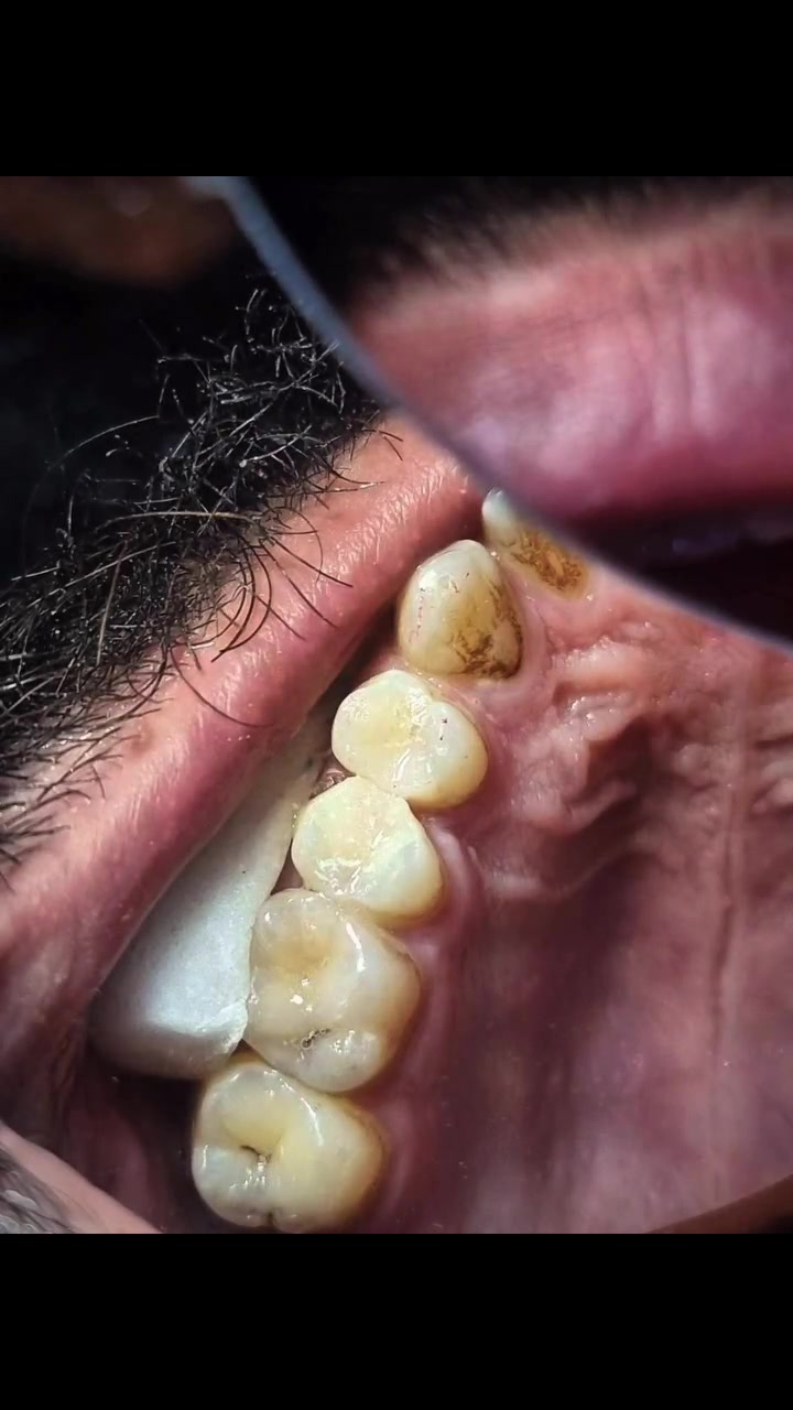 الحشوة الضوئية التجميلية ✨🦷
إذا كنت تعاني من تسوس أو كسر بسيط في الأسنان، فإن الحشوة الضوئية التجميلية هي الخيار الأمثل لاستعادة جمال ووظيفة السن

#عيادة_كوثى_لطب_وتجميل_الاسنان
#الدكتور_علي_حسن_العزاوي 
جبله/نهاية شارع الاطباء
مقابيل الدكتوره ميثاق المعموري

***********//للاستفسار

