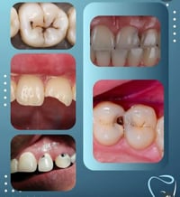 تسوس • مجاني • جامعة اوروك