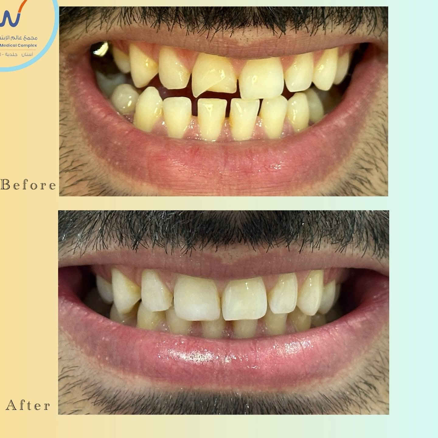 اعلاااان مهم !!
السلام عليكم .. لأن ابتسامتك مهمة تكدر تعالجها هسه بشكل مجااني ولعدد محدود جداً، بأدوات ومواد ذات كوالتي عالي جدا وبإشراف خاص

لغرض التقييم والفتره محدودة

للتواصل والحجز واتساب 

***********
