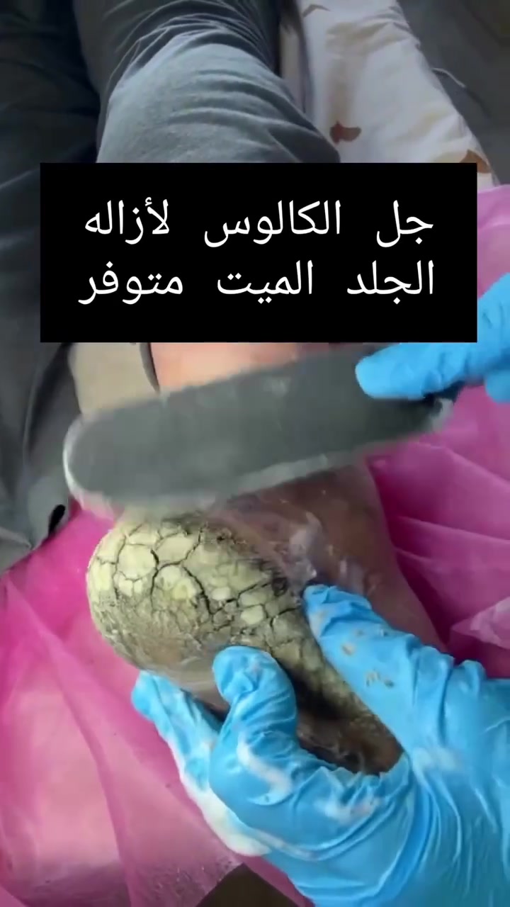 ✨ حتى أصعب التشققات تستحق عناية خاصة ✨
جل الكالوس
للتخلص من الجلد الميت المتراكم
واستعادة نعومة الكعب 👣
متوفر الآن 🤍


**إذا كنت صاحب هذا الإعلان وتريد حذفه لأي سبب، رجاءا أرسل رسالة إلى الدعم الفني**