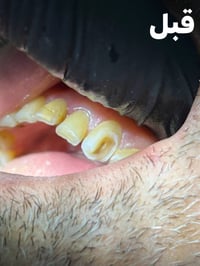 حشوة تجميلية • ضمان دائم • حي 17