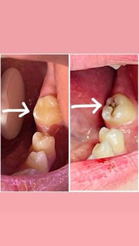 علاج مجاني • قلع أسنان • حشوات ضوئية