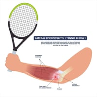 مرفق التنس" (Tennis Elbow)   هو حالة طبية مؤلمة تُعرف طبيًا بـ "التهاب...