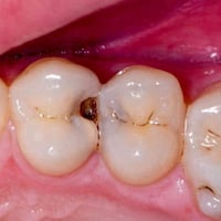 الي عنده مثل هاي تسوسات (بين الاسنان) يراسلنا على رقم  ٠٧٧٣٨٥٥٨٢٩٤ او ...