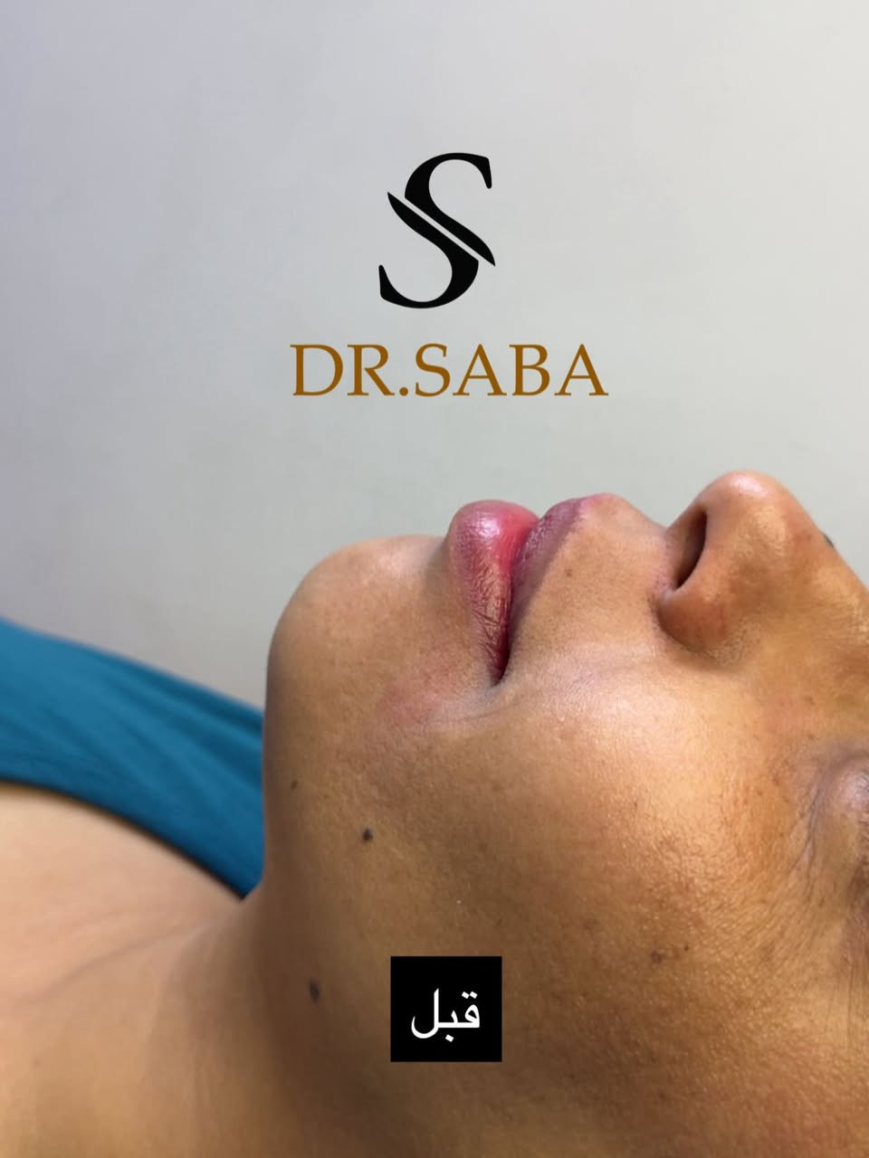 تكنيك الوجه كامل بأيدي للجميلة روح ع اخر صورة وشوفو القبل♥️🫶🏻

فلر شفة + ذقن + استدارة بسيطة
#فلر #فلرشفة_فلر_وجنات_فلرخطوط_ضاحكة_فلرذقن_تكساس_تكنيك❤️❤️❤️ #فلر_بوتكس #فلر_شفايف👄


**إذا كنت صاحب هذا الإعلان وتريد حذفه لأي سبب، رجاءا أرسل رسالة إلى الدعم الفني**