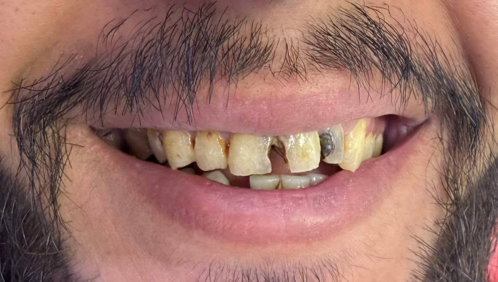 تم معالجة الأسنان بحشوات الجذر وتغليفها الزيركون مدة العمل اسبوع واحد
العنوان ميسان الماجدية شارع الملعب خلف مركز الشرطة أمام جامع الثقلين 
الدكتورة رويدة كاظم 
للحجز والاستفسار 
***********
البتول لطب الاسنان عمارة, ميسان
