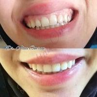 بوتوكس خفيف ✔ فيلر طبيعي ✔ علاج الابتسامة اللثوية ✔ ابتسامة… ناعمة، مت...