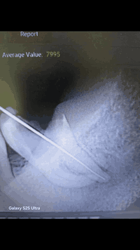 علاج سن العقل • مركز الرواسي • دكتور سيف رعد