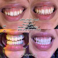 جلسة تبييض • فلر شفايف • الحمزة الشرقي